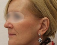 Profil twarzy kobiety po operacji liftingu twarzy