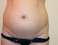 brzuch przed liposukcją