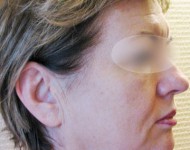 Profil twarzy przed liftingiem